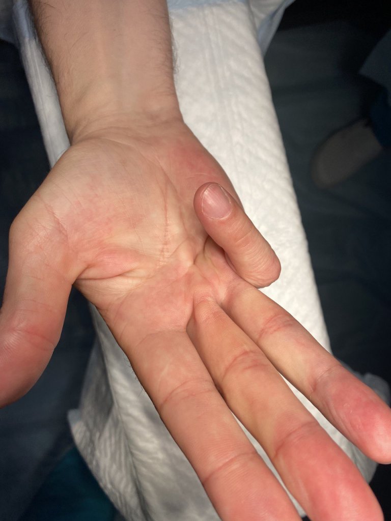 Иссечение контрактуры_1.jpg