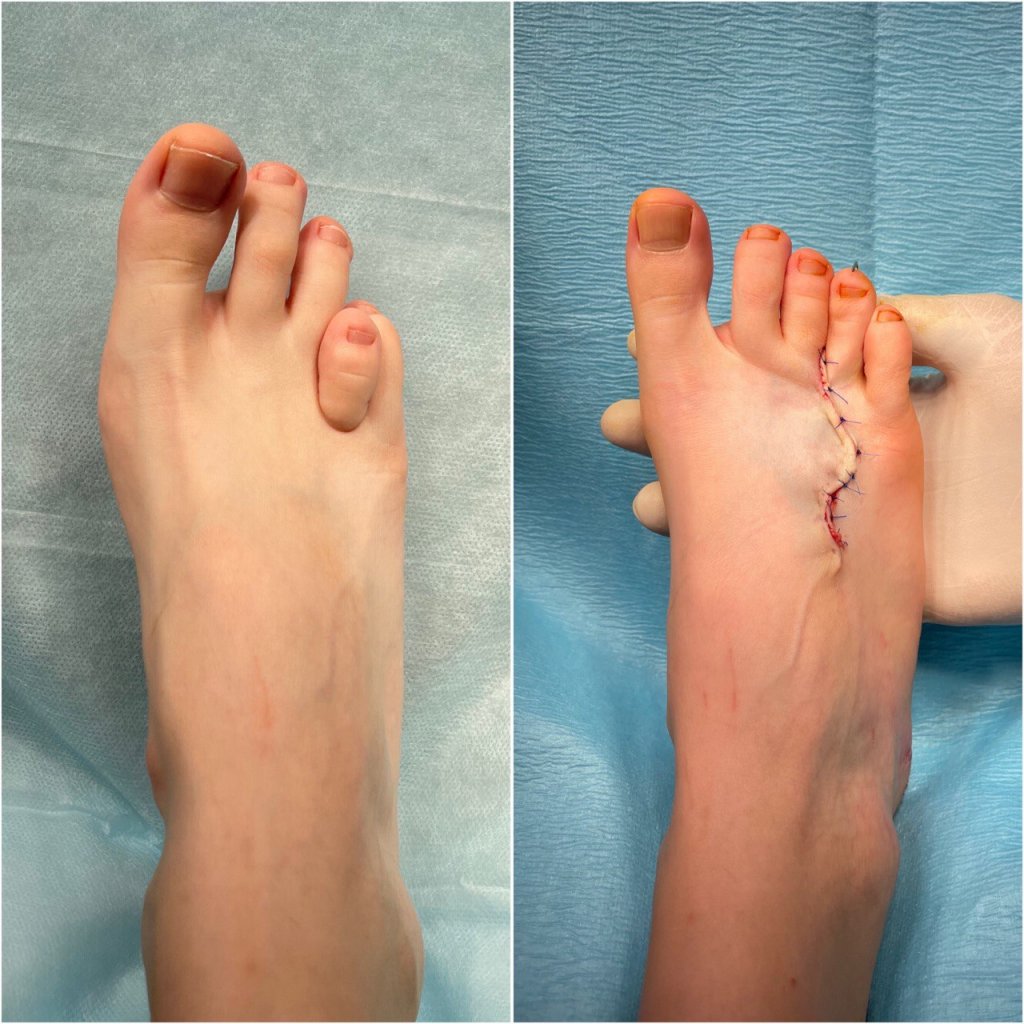 Лечение брахиметатарзии_1.jpg